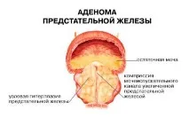 Простатит, наслідки для чоловіків, а також чим небезпечний і на що впливає, чому немає сперми після також