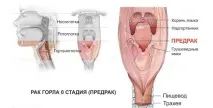 Рак горла у чоловіків перші ознаки та симптоми (фото) чоловіків