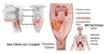 Рак горла у чоловіків перші ознаки та симптоми (фото) ознаки