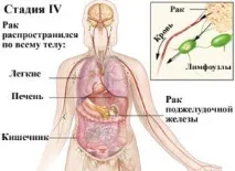 Рак шлунка лікування, стадії, діагностика, вартість, відгуки стадії