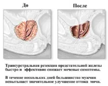 Реабілітація після видалення аденоми простати видалення