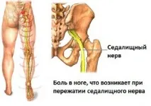 Сідничний нерв лікування ішіасу в Центрі остеопатії нерв