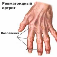 Синдром Рейно симптоми та лікування лікування