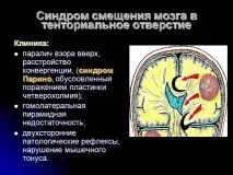 Синдром Парино (параліч вертикального погляду) причини, симптоми, лікування синдром