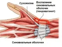 Тендовагініт стопи, сухожилля, гомілковостопного суглоба що це таке, симптоми та лікування стопи