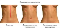 міхура