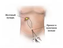 міхура