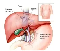 Тромбоз печінки - симптоми, причини, діагностика, лікування тромбоз