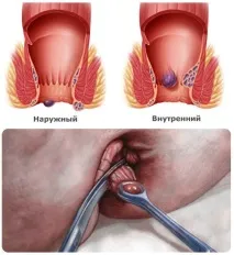 гемороїдального