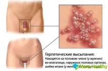 Пухирі на статевих губах (генітальний герпес) пухирі