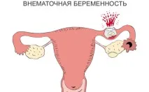 ХГЛ при подвійні (багатоплідної вагітності) таблиця по днях таблиця