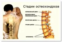 4 стадії остеохондрозу причини, симптоми, лікування симптоми