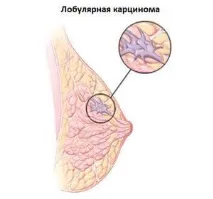 Аденокарцинома молочної залози в Ізраїлі, 5308$ ціна 2018 залози