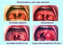 Ангіна фото, симптоми та лікування в домашніх умовах у дорослих симптоми