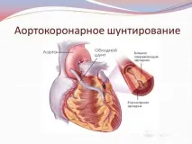 шунтування