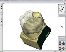 CEREC 3 зйомки