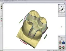 CEREC 3 зйомки