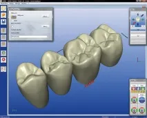 CEREC 3 CEREC