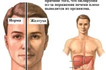 Цироз печінки симптоми, взаємозв’язок із гепатитом С печінки