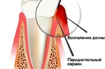 Як лікувати кровоточивість ясен у домашніх умовах домашніх
