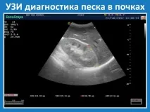 Як лікувати пісок у нирках, методи народної медицини та рецепти виведення лікувати