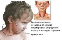 Як виявляється патологія криві у новонароджених - профілактика виявляється