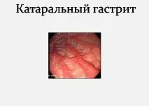Катаральний гастрит - Дієта при катаральному гастриті. гастрит