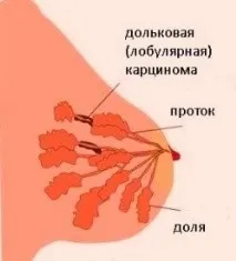 Лікування долькової карциноми in Situ в Ізраїлі, Іхілов лікування