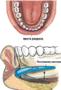 Ментопластика (Пластика підборіддя) підборіддя