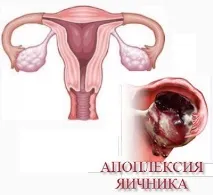 Симптоми та лікування апоплексії яєчника апоплексії