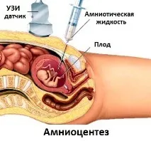 Синдром Дауна ознаки при вагітності, аналіз на Дауна під час вагітності ознаки