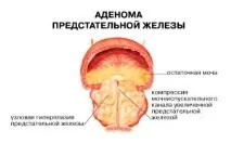 Слабкий струмінь (натиск) сечі у чоловіків причини поганого відходу сечі та її підтікання у сильної статі натиск