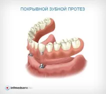 Покривний зубний протез протез