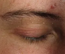 Прищ на віку під оком, між бровами, на бровах оком