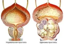 Простатит та аденома захворювання