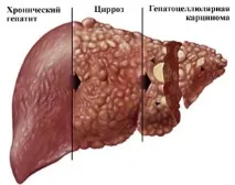 печінки