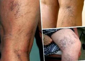 lipitorului terapia
