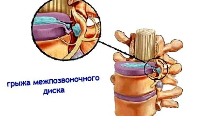 остеохондроза лумбална