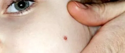 tratamentul varicelor