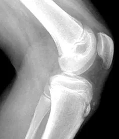 schlatter-osgood schlatter-osgood