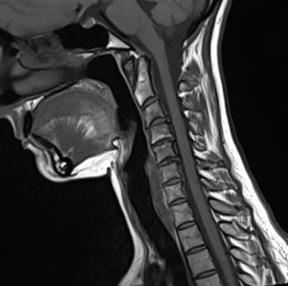 osteoporoza cervicale