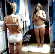 nervosa anorexia