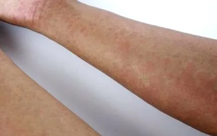 creșterea eczemele