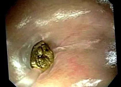 stomacului