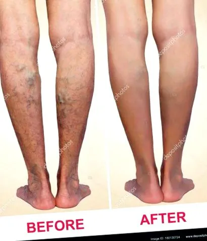 roaccutane roaccutane