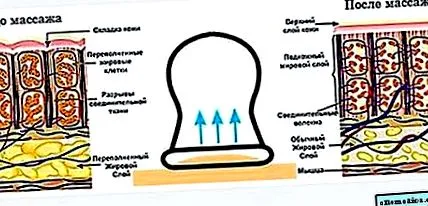 припари артроза