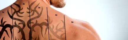 лазерне видалення