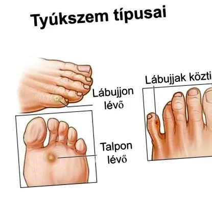 мазоли лечение