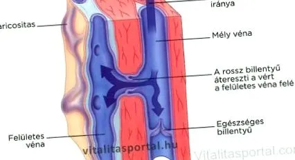 varicelor varicelor