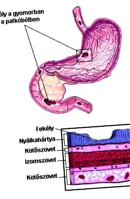 виразки симптоми
